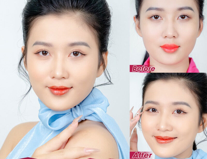 Cắt mí mắt Hàn Quốc 7 dr eye ni nhan mi 12 e1758702597431