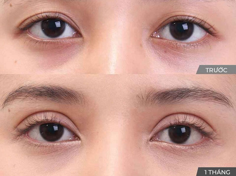 Nhấn mí mắt 3 dr eye ni nhan mi 3 e1758701541460