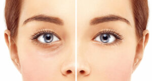 Phẫu thuật điều trị trễ mi dưới