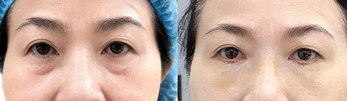 Phẫu thuật điều trị trễ mi dưới 10 dr eye phau thuat dieu tri tre mi duoi 12 1 e1758707763896
