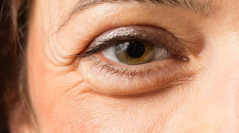 Phẫu thuật điều trị trễ mi dưới 4 dr eye phau thuat dieu tri tre mi duoi 3 e1758707542782