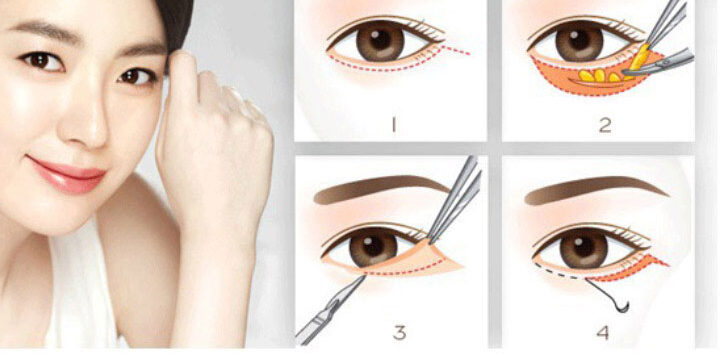 Phẫu thuật điều trị trễ mi dưới 3 dr eye phau thuat dieu tri tre mi duoi 4 e1758707583356
