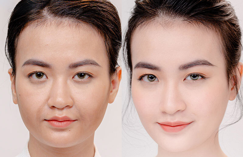 Phẫu thuật điều trị trễ mi dưới 5 dr eye phau thuat dieu tri tre mi duoi 5 e1758707625112