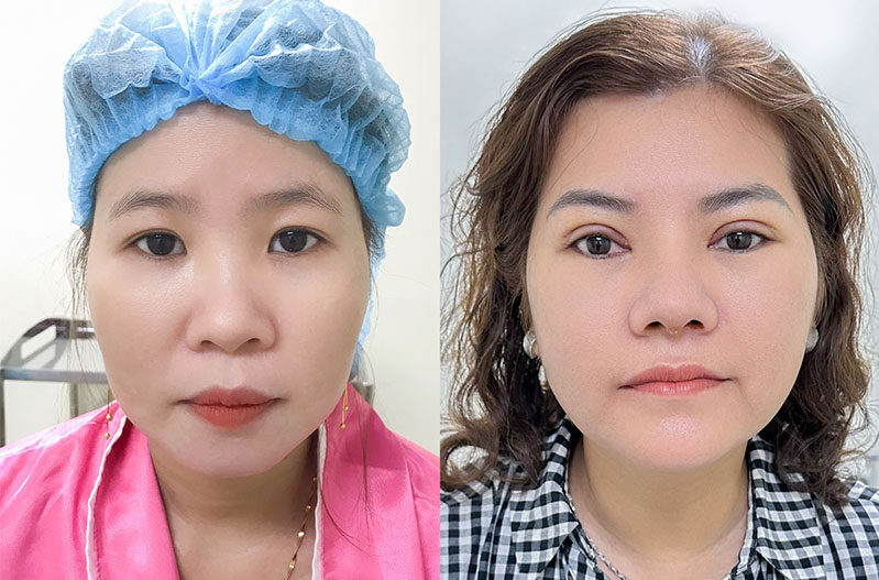 Tạo hình mí mắt trên 4 dr eye ub tao hinh mi mat tren 5 e1758706889979