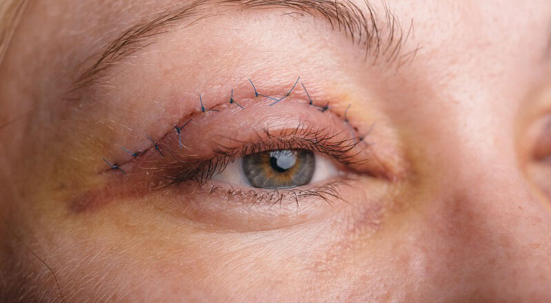 Xử lý vết thương phần mềm nông vùng mi mắt 3 dr eye xu ly vet thuong phan mem nong vung mi mat 2 e1758708940183