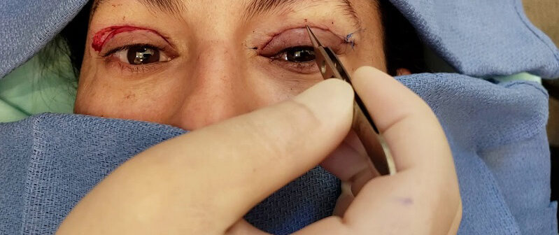 Xử lý vết thương phần mềm nông vùng mi mắt 2 dr eye xu ly vet thuong phan mem nong vung mi mat 3 e1758708934640
