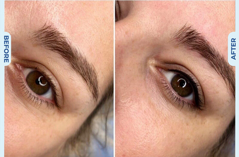 Tạo hình mi mắt 9 dr eyelid 11 e1758854910832