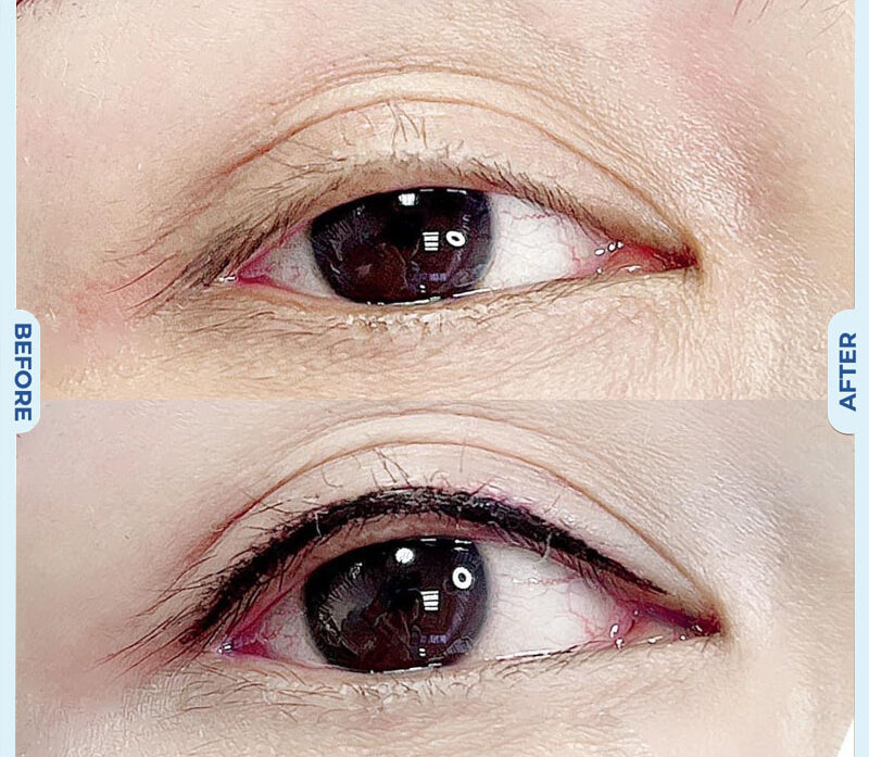 Tạo hình mi mắt 10 dr eyelid 12 e1758854936222
