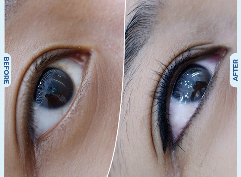 Tạo hình mi mắt 11 dr eyelid 13 e1758854968582