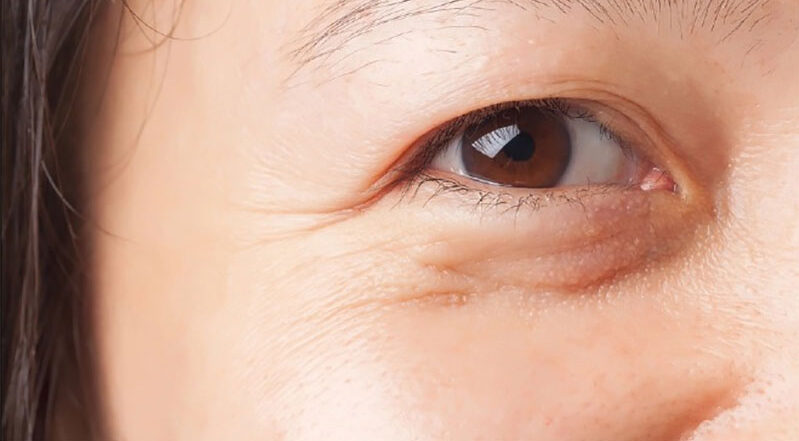 Loại bỏ mỡ bọng mắt 1 ge7cNYaP dr eye loai bo mo bong mat 1 e1758874515811