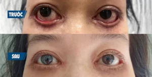 Chỉnh cơ mí mắt