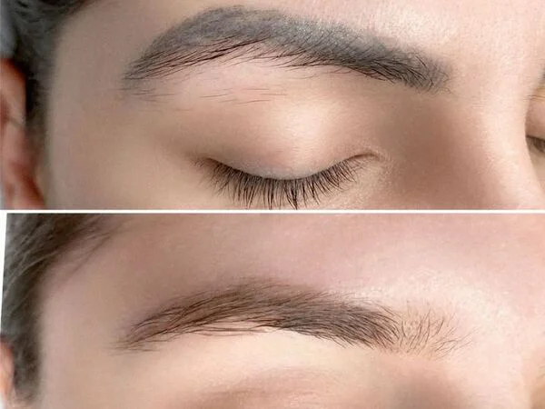 Các phương pháp xóa điêu khắc chân mày nữ hiện nay Các phương pháp xóa điêu khắc chân mày nữ hiện nay