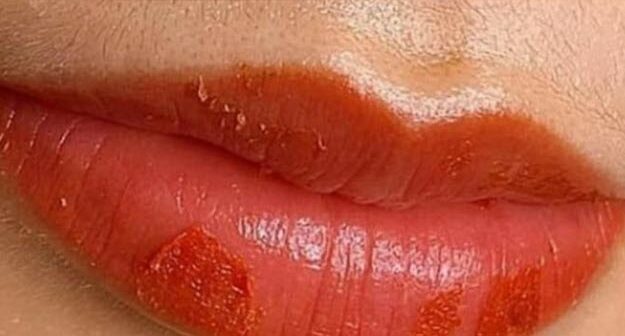 Quá trình phục hồi sau phun môi như thế nào? Các mốc thời gian bạn cần biết 3 hinh anh sau phun moi bong vay 033939704 e1763362878665