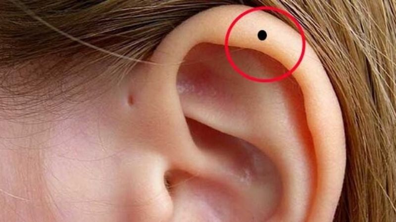 Nốt ruồi ở tai – Tổng quan và ý nghĩa theo vị trí 1 Nốt ruồi ở tai là gì?