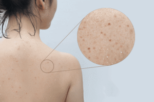 trị thâm mụn lưng