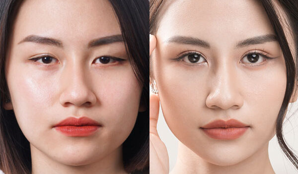 Cắt mí full là gì? So sánh cắt mí mắt full và cắt mí mini