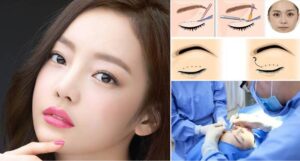 kinh nghiệm đi cắt mí mắt