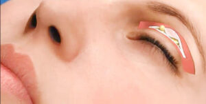 Lấy mỡ nội soi mí mắt