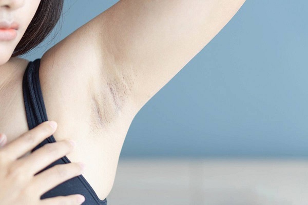 Triệt lông nách có hết thâm nách không?