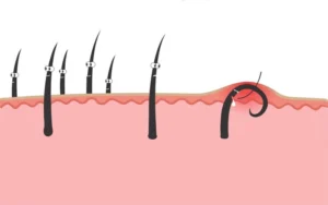 Triệt lông có bị lông mọc ngược