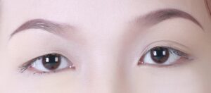 Mắt một bên 2 mí một bên 1 mí là do đâu? Cách khắc phục hiệu quả