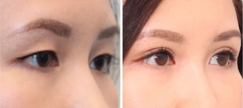 Sau phẫu thuật cắt mí mắt, thời gian kiêng ăn thịt vịt thường kéo dài từ 1 đến 2 tháng Sau phẫu thuật cắt mí mắt, thời gian kiêng ăn thịt vịt thường kéo dài từ 1 đến 2 tháng