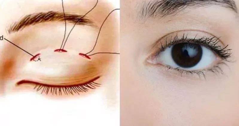 Mắt 2 mí là gì? Cách tạo mắt 2 mí đẹp tự nhiên 8 mat 2 mi 8 e1758784774233