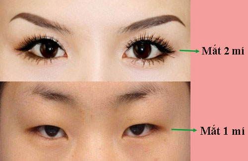 Phân biệt đôi mắt 1 mí và 2 mí