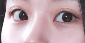 Mắt 3 mí là gì? Vận mệnh và cách khắc phục mắt 3 mí