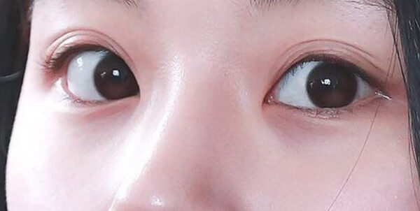 Mắt 3 mí là gì? Vận mệnh và cách khắc phục mắt 3 mí