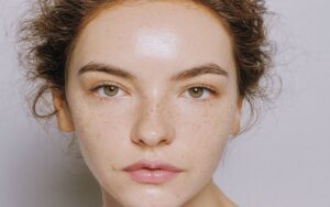 Nám nhẹ 2 bên gò má