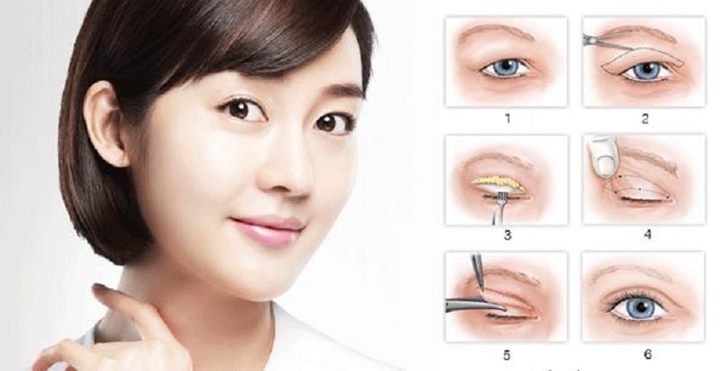 Nên cắt mí hay nâng chân mày? Đánh giá chi tiết hai phương pháp cắt mí và nâng cung mày 7 mat buon 8