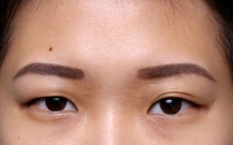 Mắt cao mắt thấp là như thế nào? Cách khắc phục an toàn