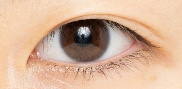 Mắt cụp là gì? Nguyên nhân và cách khắc phục mắt cụp