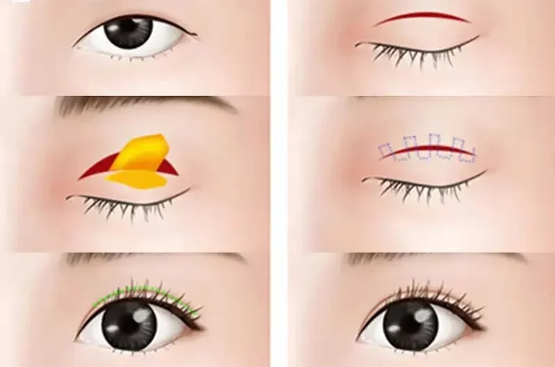 Mắt sụp mí nên cắt mí hay treo chân mày? 3 mat ho ly 6 e1758853267508