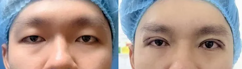 Mắt lươn là gì? Tướng số tốt hay xấu ở nam và nữ 6 mat luon 5 e1758862760651