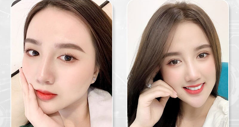Mắt mí lót là gì? Cách khắc phục mí lót thành 2 mí 6 mat mi lot 7 e1758782843260