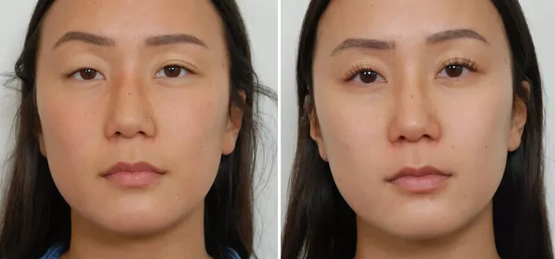 Mắt một bên 2 mí một bên 1 mí là do đâu? Cách khắc phục hiệu quả 3 mat mot ben 2 mi mot ben 1 mi 3 e1758783080606