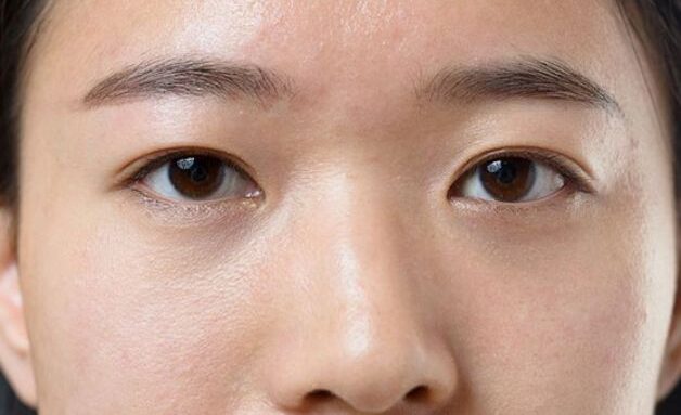 Mắt mí lót là gì? Cách khắc phục mí lót thành 2 mí