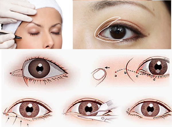 Mở rộng góc mắt trong 1 Mở rộng góc mắt trong