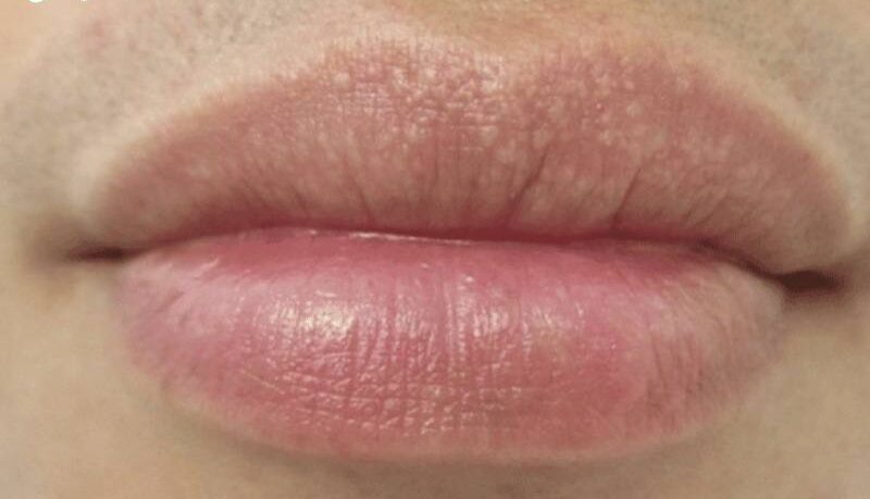 Môi bị hạt fordyce phun xăm có được không? Cần lưu ý gì? 2 moi bi hat fordyce co phun moi duoc khong 2 674e6213cbbd2 e1757658173604