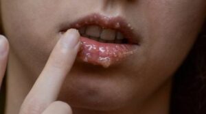 Phun môi bị mụn nước có nguy hiểm không? Cảnh báo biến chứng cần biết