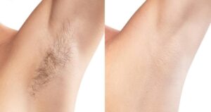 Mỗi lần triệt lông nách cách nhau bao lâu