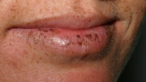 Phun môi bị đốm đen