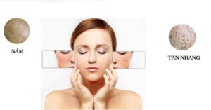 Cách đơn giản nhất để giảm thâm nám và tàn nhang là gì?