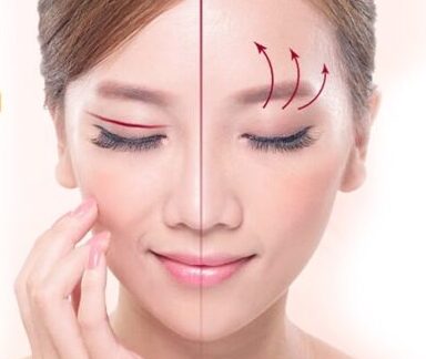 Nên cắt mí hay nâng chân mày? Đánh giá chi tiết hai phương pháp cắt mí và nâng cung mày