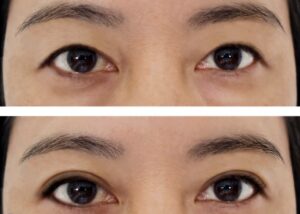 Nếp mí rẻ quạt | Đẹp hay xấu? Cách khắc phục như thế nào?