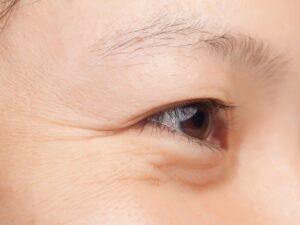 Nếp nhăn dưới mắt