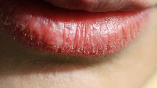 Môi bị rát sau khi bong có sao không? Cách xử lý an toàn