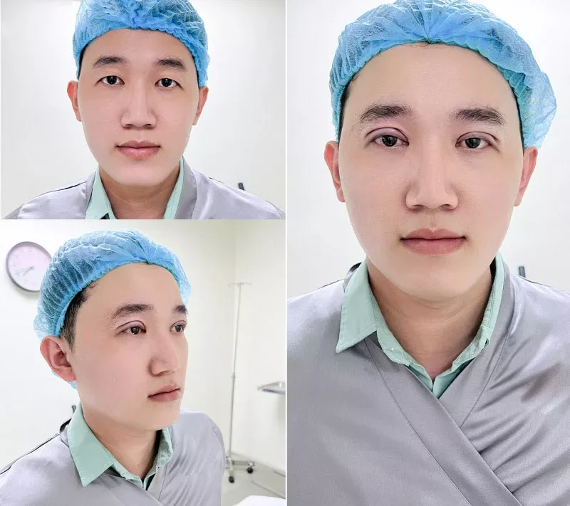 Nhấn mí nam giới là gì? Khác biệt gì so với nữ giới? 8 nhan mi nam 11 e1758703113513